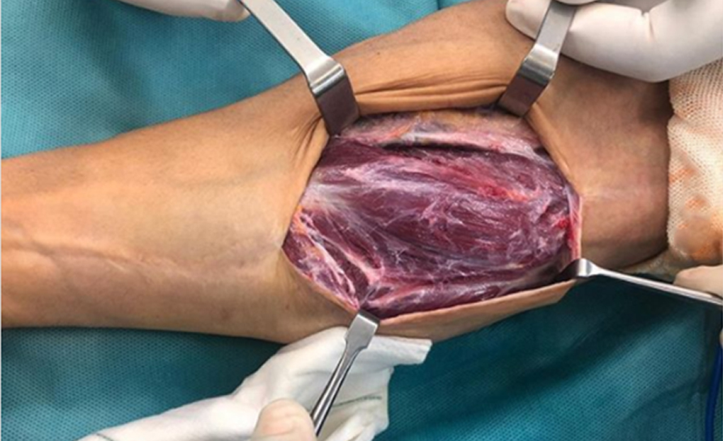 MotoGP, 2020, San Marino: Crutchlow operado outra vez