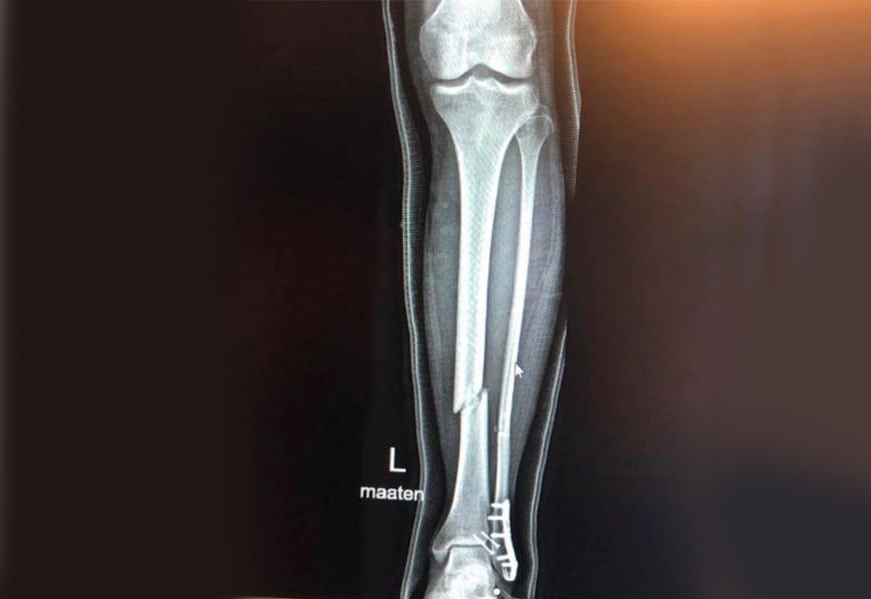 MotoGP, 2021: Mika Kallio sofre uma fratura da tíbia e fíbula