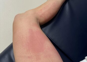 MotoGP: Alex Rins revela a queimadura sofrida no GP da Tailândia